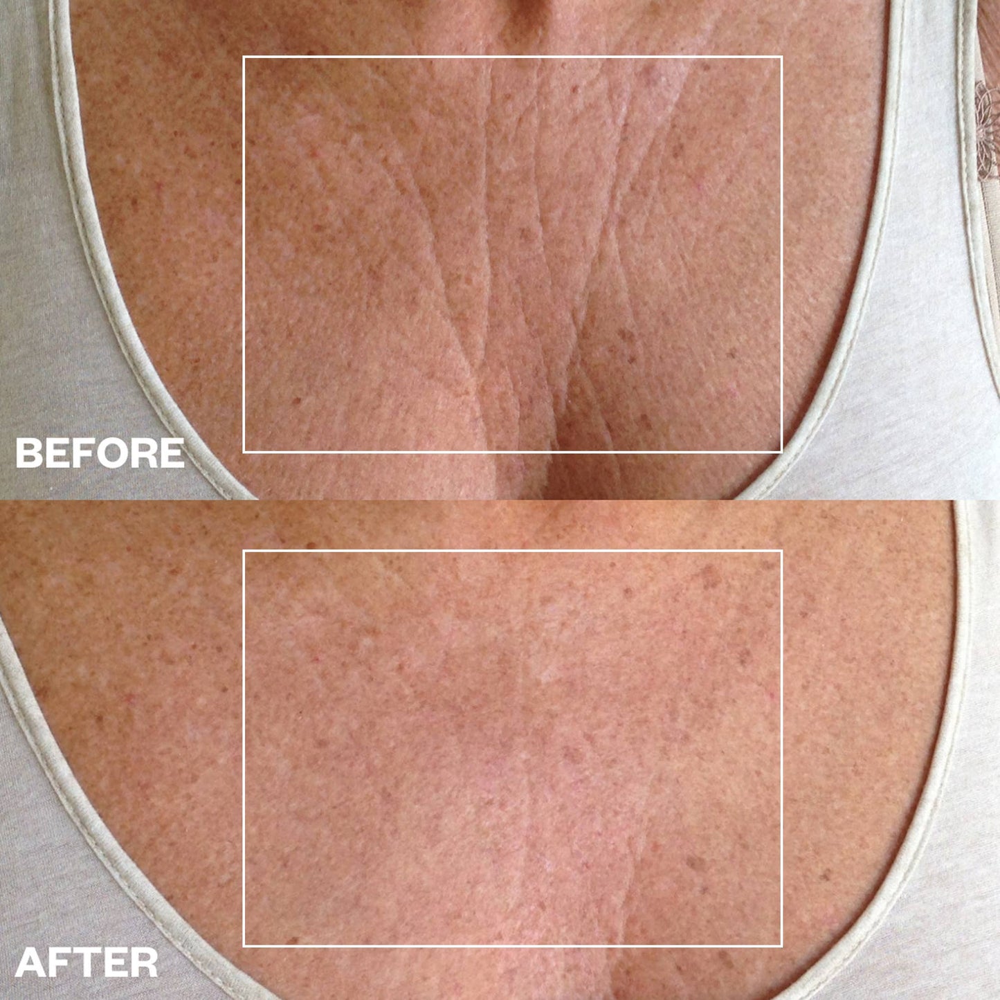 Chest Wrinkle Patch
