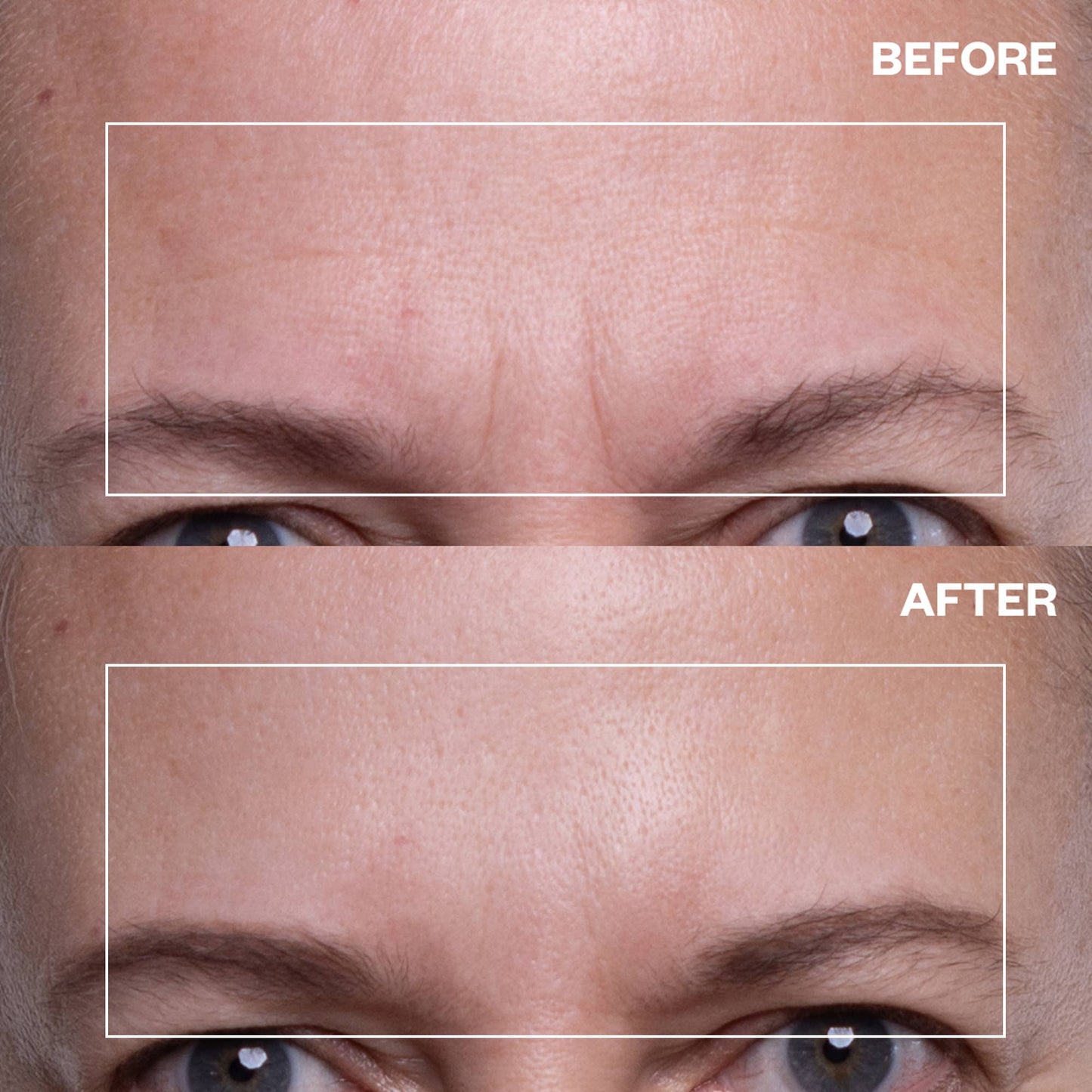 Forehead Wrinkle Patches