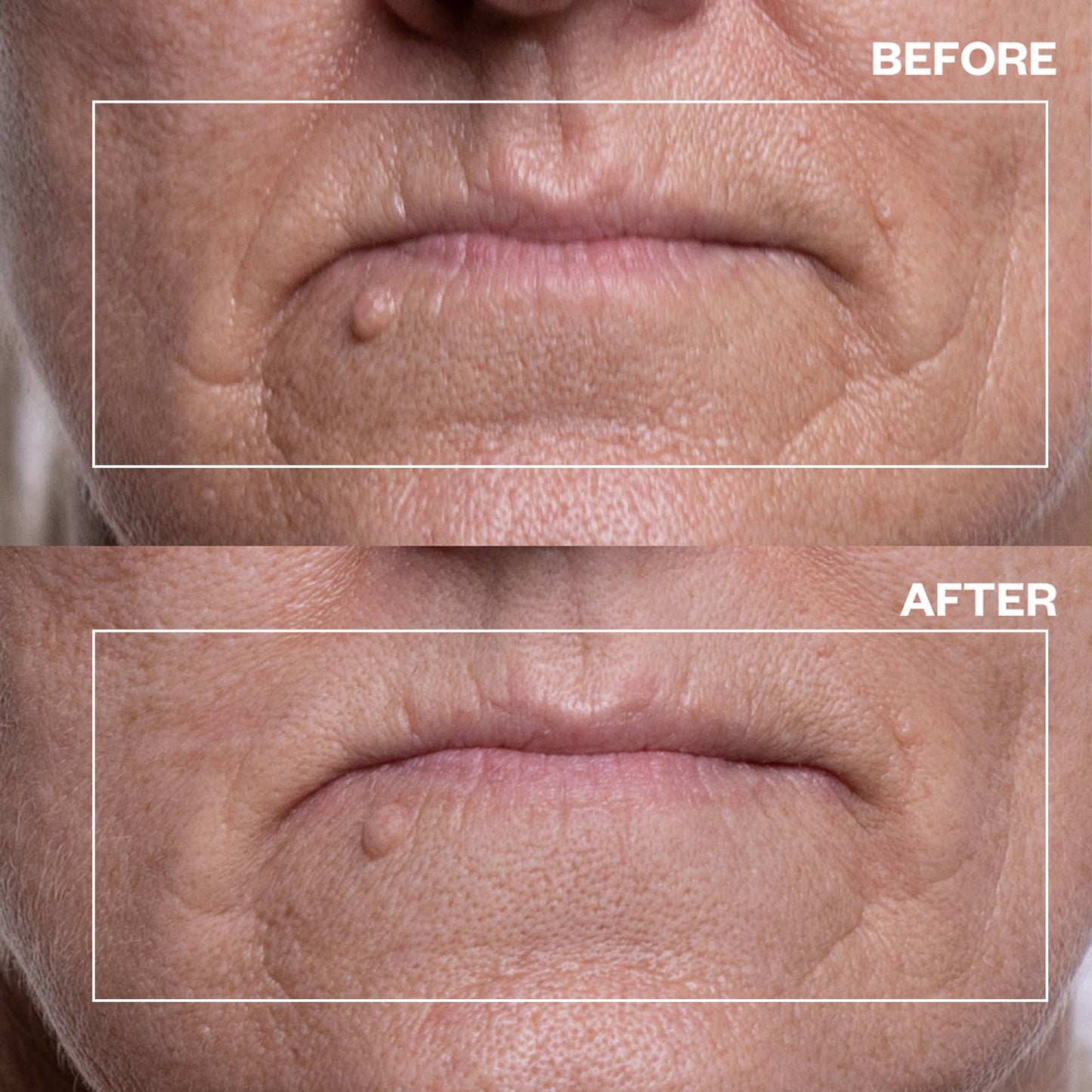 Mouth Wrinkle Patches