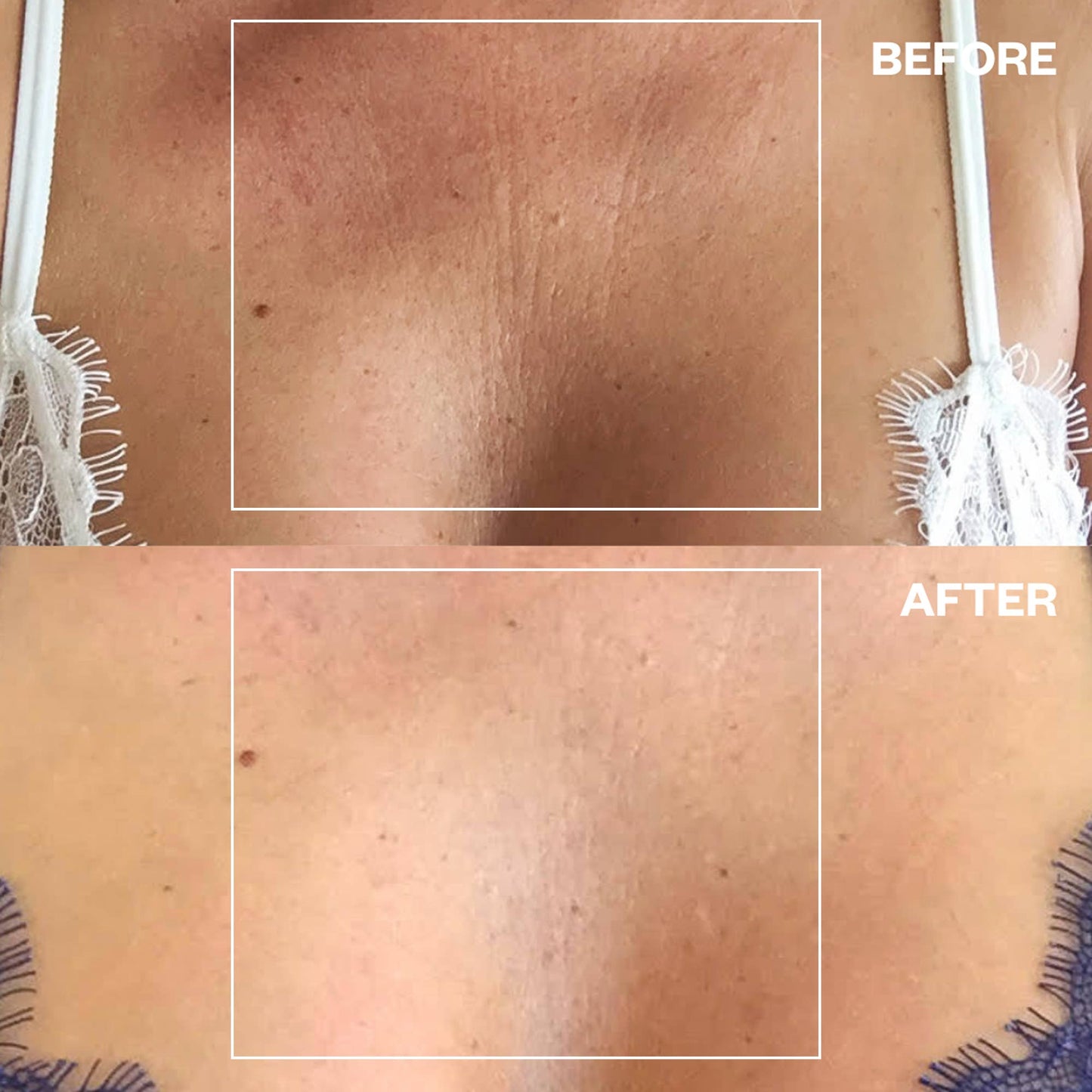 Chest Wrinkle Patch