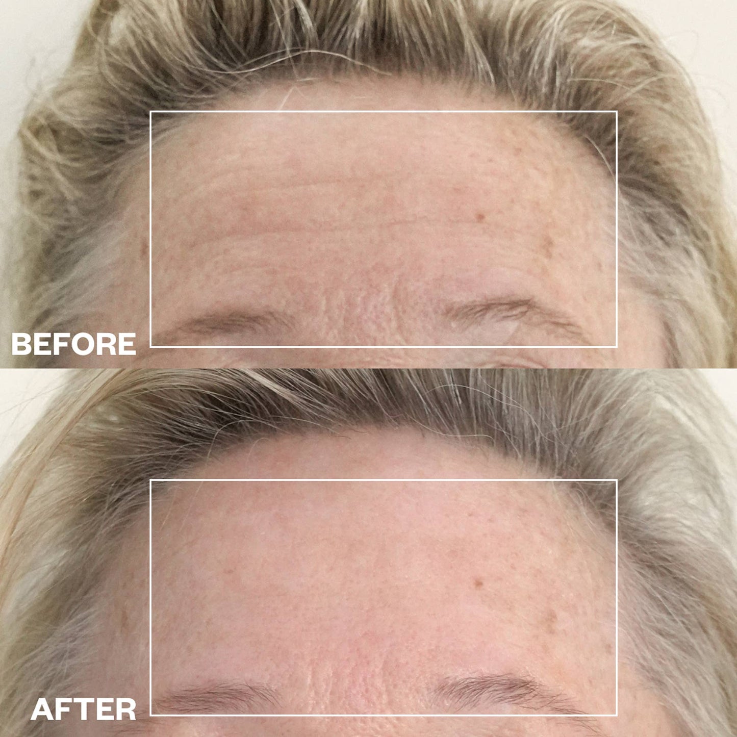 Forehead Wrinkle Patches