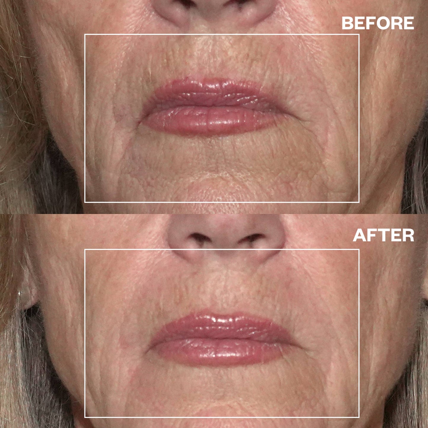 Mouth Wrinkle Patches
